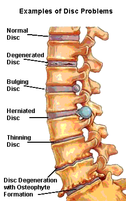 Disc Herniations